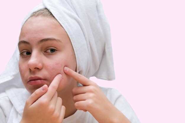 Understanding Acne